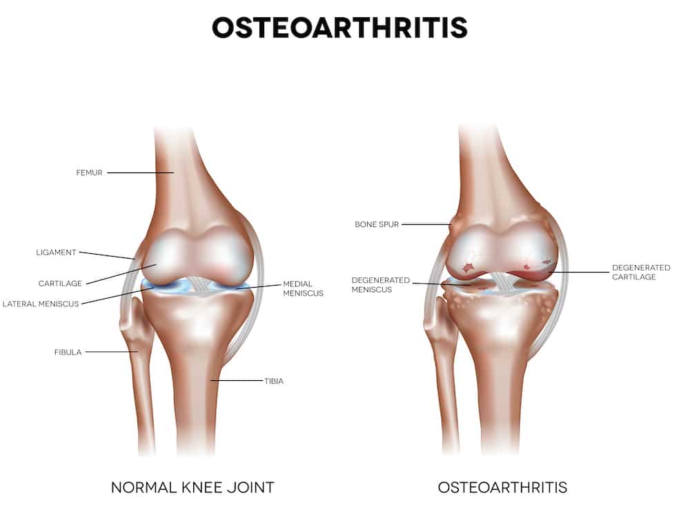 Diagram of normal and osteoarthritis in joint